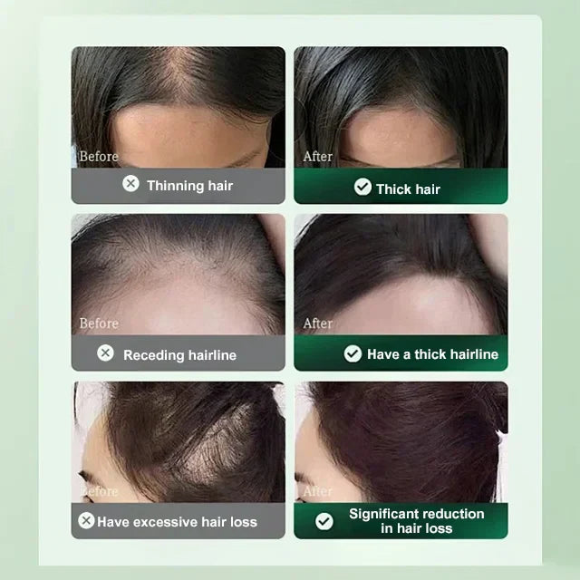 Last Day Of Discount 🔥 Rosemary Hair Growth Spray