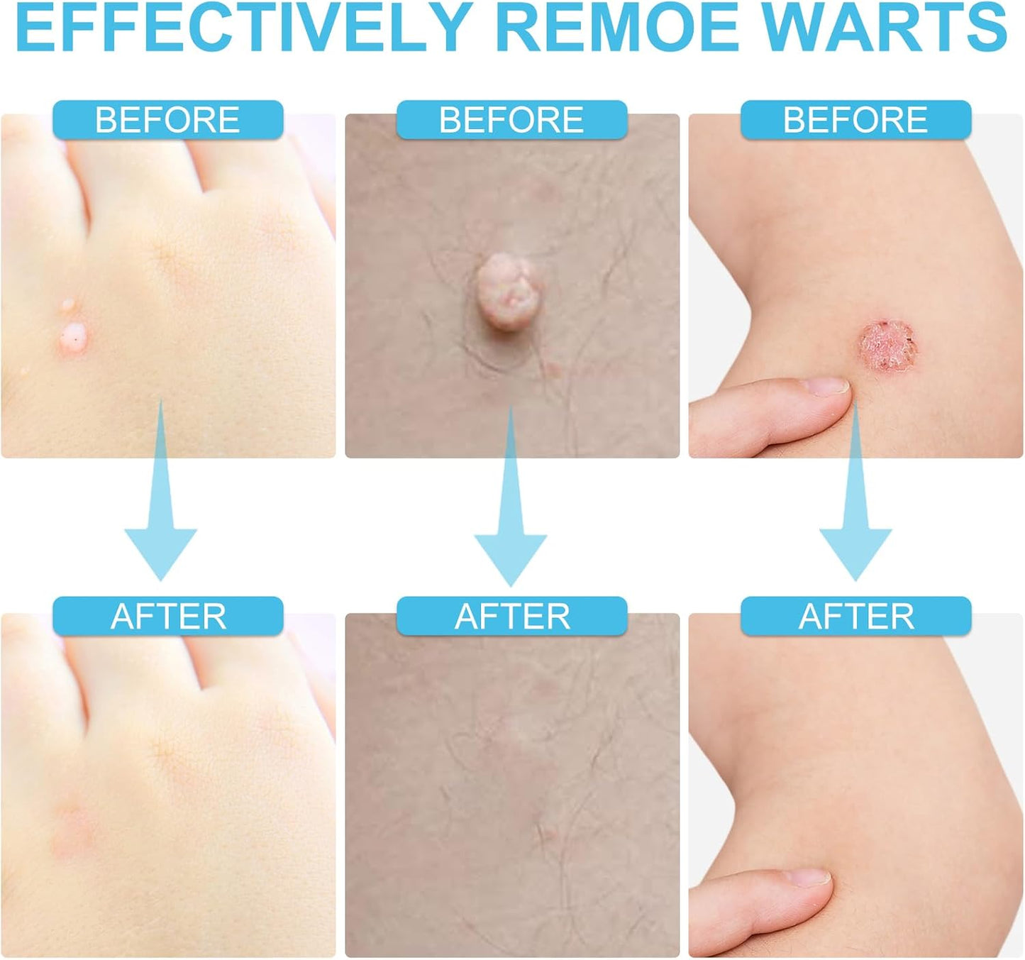 LAST DAY OF DISCOUNT 🔥 Mole and wart removal cream