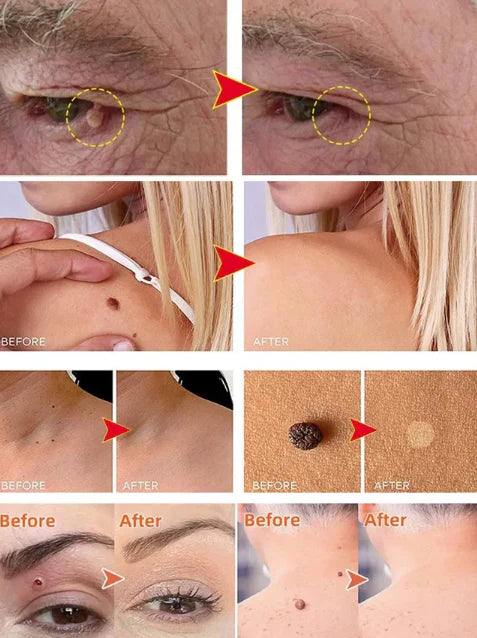 LAST DAY OF DISCOUNT 🔥 Mole and wart removal cream